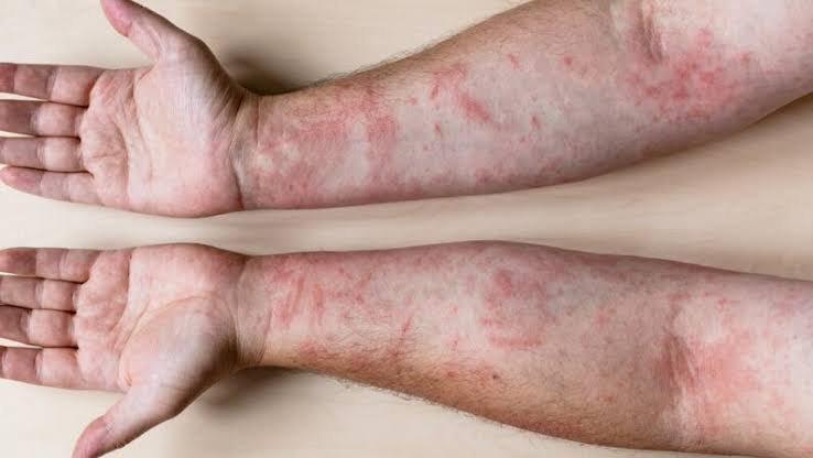 O que a Doença do Carrapato faz em Humanos - Febre Maculosa e Sintomas