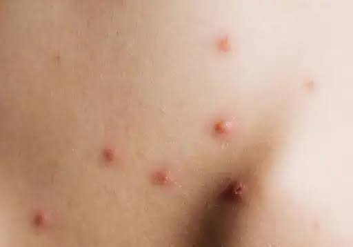 Pulgas picam só animais ou humanos também - Dermatite e Alergias